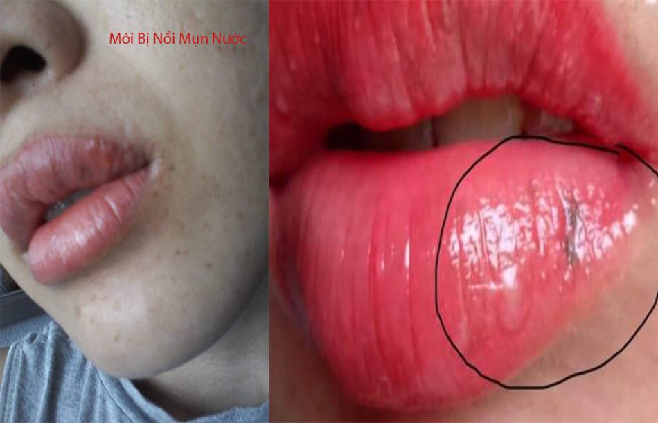 Mách bạn cách xử lý phun môi bị viêm sưng hiệu quả  Long huyết PH tan bầm  tím giảm sưng đau